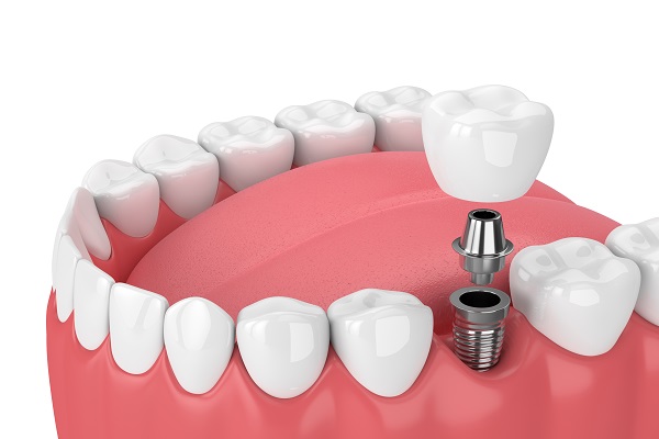 Dental Implants &#    ; Cosmetic Dentistry For Missing Teeth