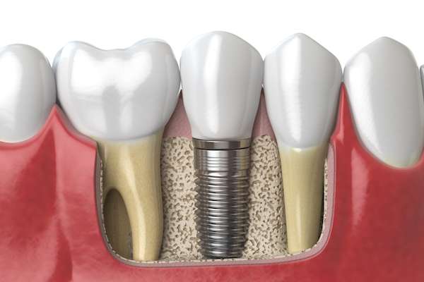 Dental Implants for Replacing Missing Teeth from Core Dental Group and Implants Center in Quincy, MA