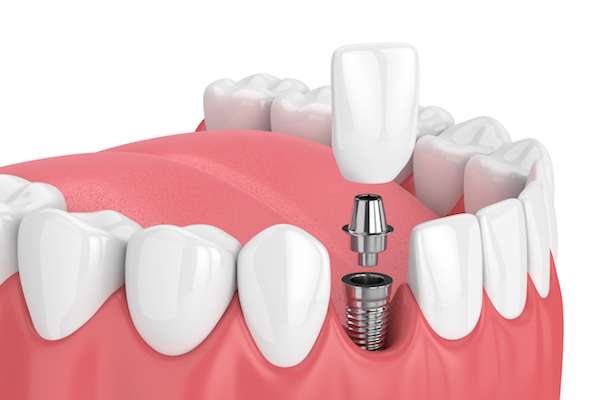 How Painful is Dental Implant Surgery from Core Dental Group and Implants Center in Quincy, MA